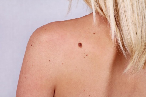 Mole Removal Clinic in Dubai