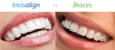 Invisalign Braces in Greater Kailash 1 - orion Dental clinic