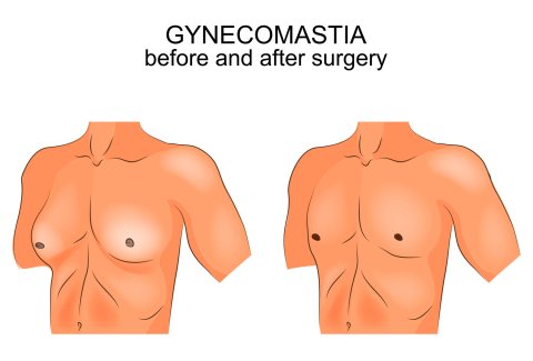 Gynecomastia surgery in Lahore