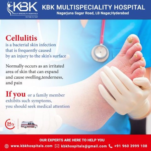 Cellulitis Specialist Doctor in Hyderabad
