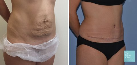 Tummy tuck in lahore