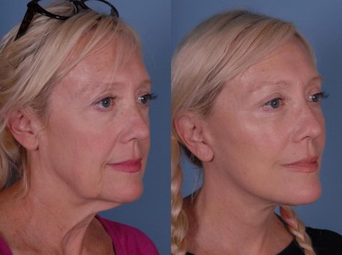 Facelift surgery cost in lahore