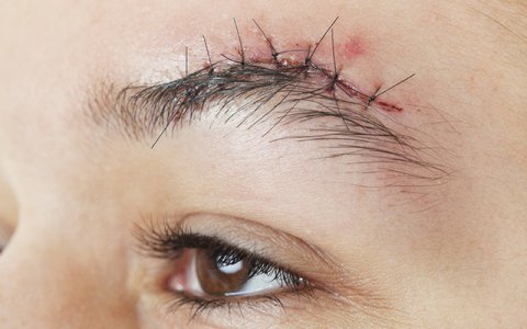 Suture Removal At Home in Dubai