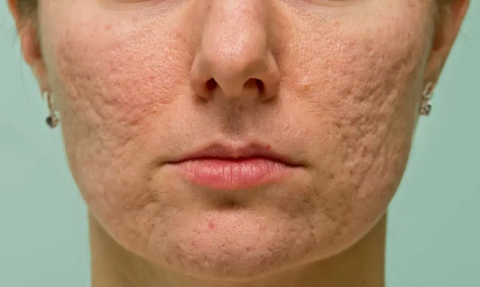 Clear, Radiant Skin: Dealing with Acne Scars