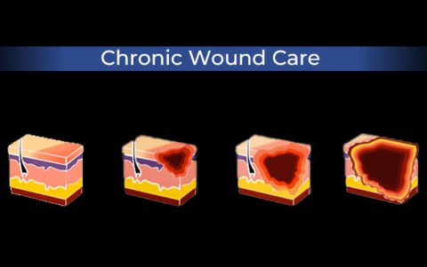 healing chronic wounds