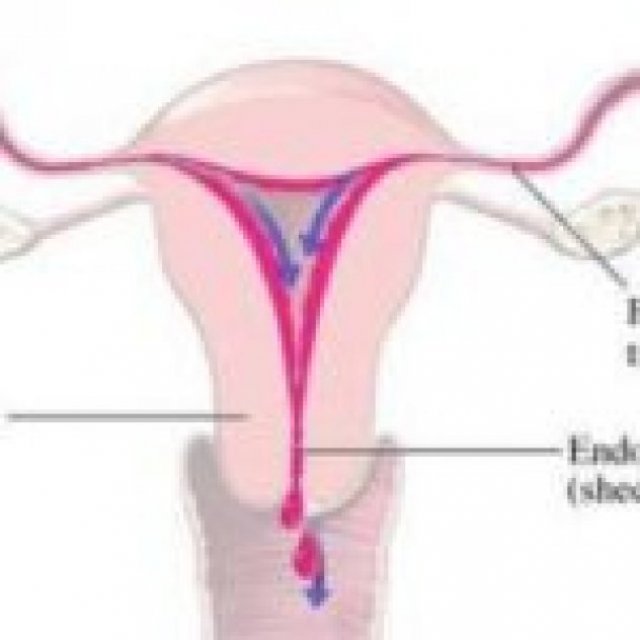 Myomectomy Fibroids