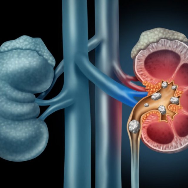 Nephrectomy Kidney Removal Brooklyn