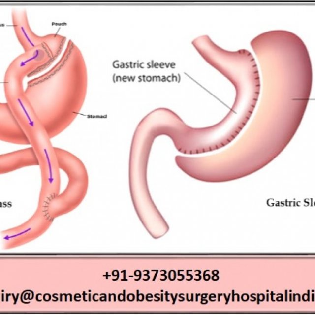 Top 10 hospital for Roux-en-Y Gastric Bypass in India