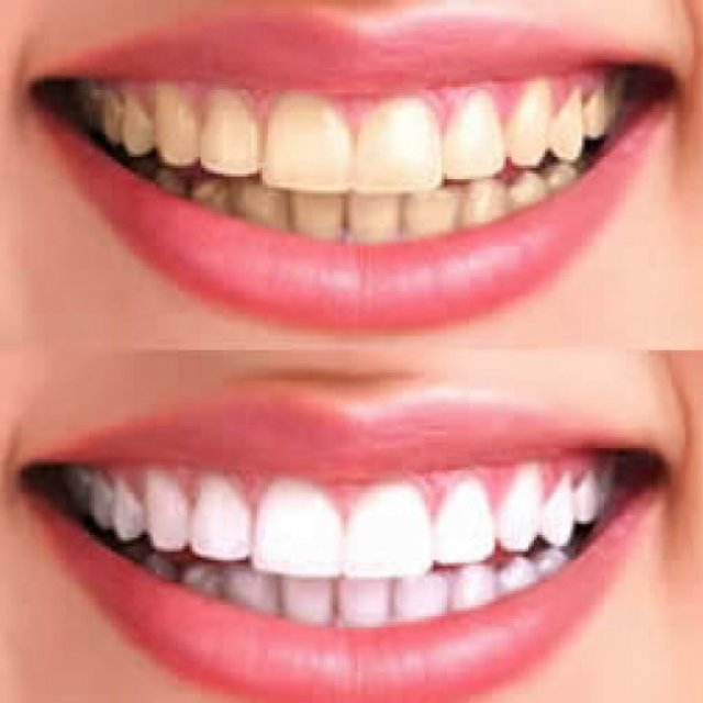 Teeth Whitening Aventura - Aventura Bright Smiles