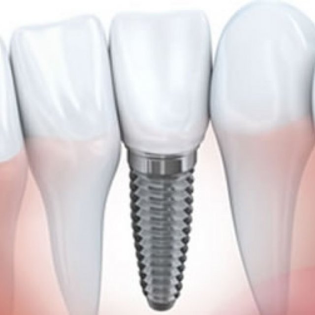 Dental Implants in Louisville - Billsmythe Dentist
