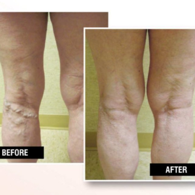 USA Vein Clinics
