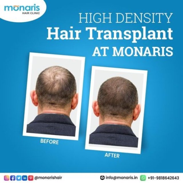 Hair Transplant in Delhi - monaris skin and hair clinic
