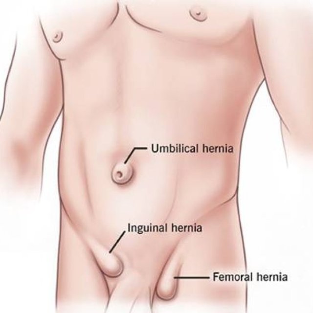 Hernia Specialist Doctor In Moshi Pune