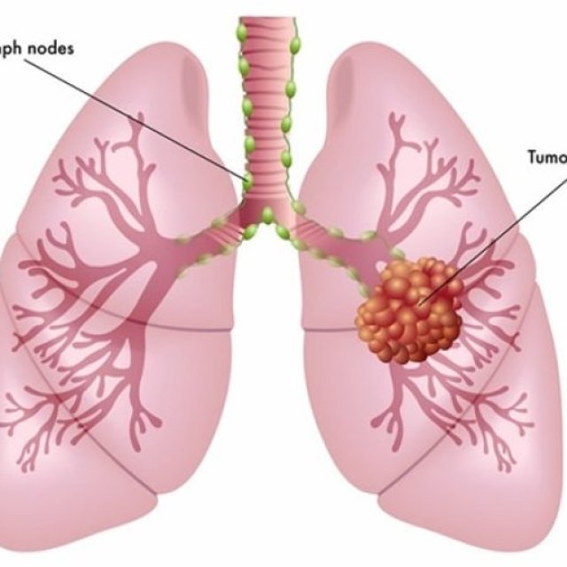 Lung Cancer Treatment  in India - Dr. Arvind Kumar