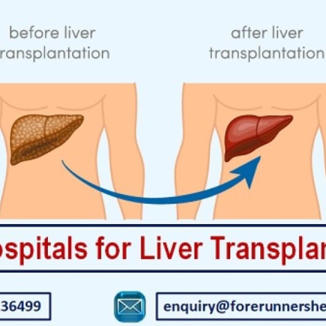 Low Cost liver transplant india