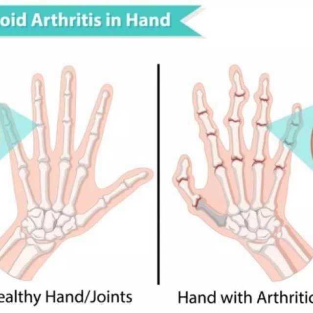 Rheumatoid Arthritis in Hindi