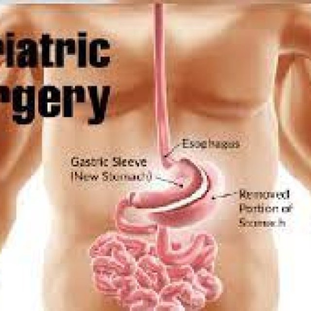 Gastric Bypass Surgery in Delhi