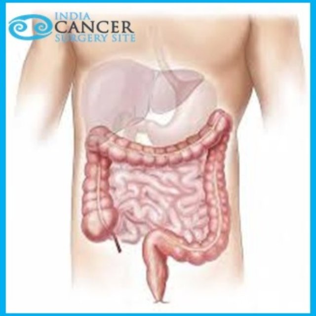 Top Oncologist For Colon Cancer India