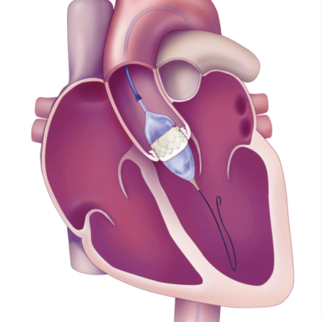 Pacemaker Implantation Treatment in India