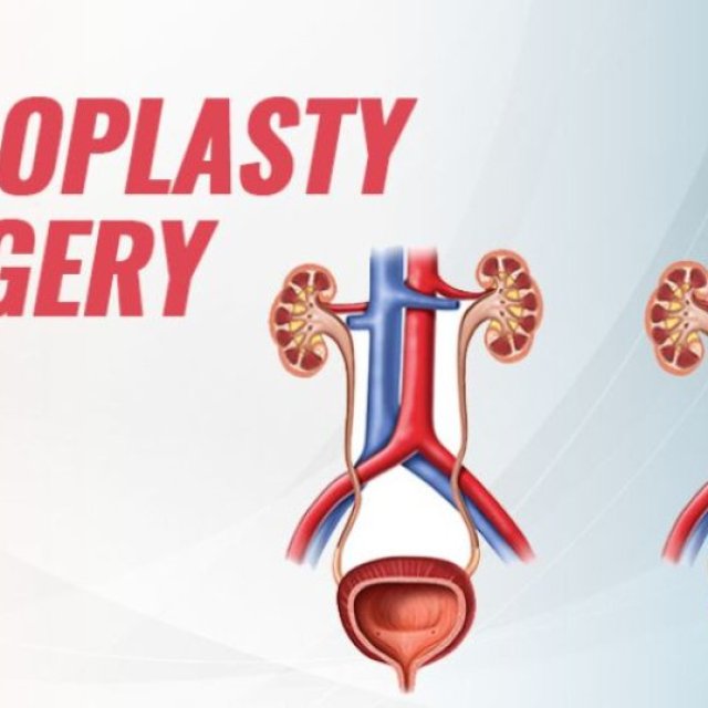Pyeloplasty Surgery in Bangalore | Worldofurology