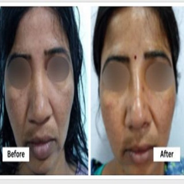 Rhinoplasty nose surgery in Hyderabad