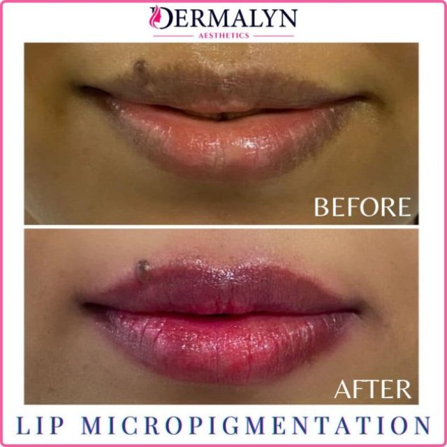 Micropigmentation of Lips