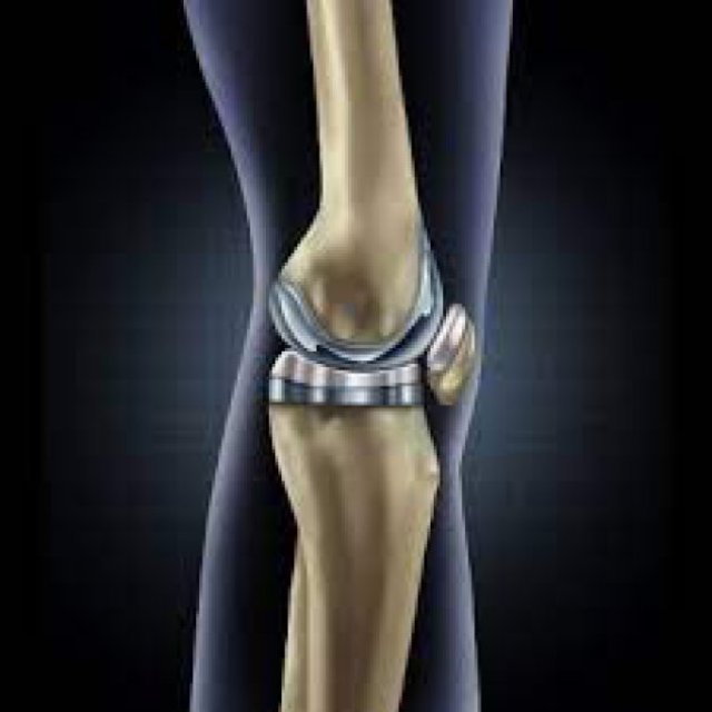 Cost of Knee Replacement Surgery In India