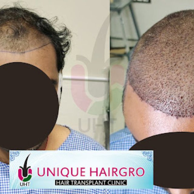 Unique Hair Grow Hair Transplant Clinic
