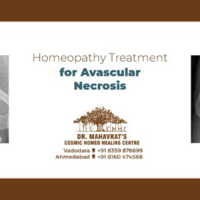 Homeopathic Treatment for Avascular Necrosis in Ahmedabad | Dr.Mahavrat Patel