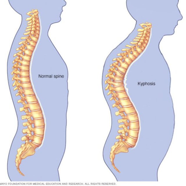 Spinal Surgery Cost in India Affordable