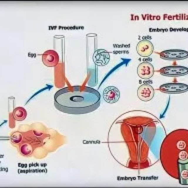 Introduction To IVF Treatment In Dwarka