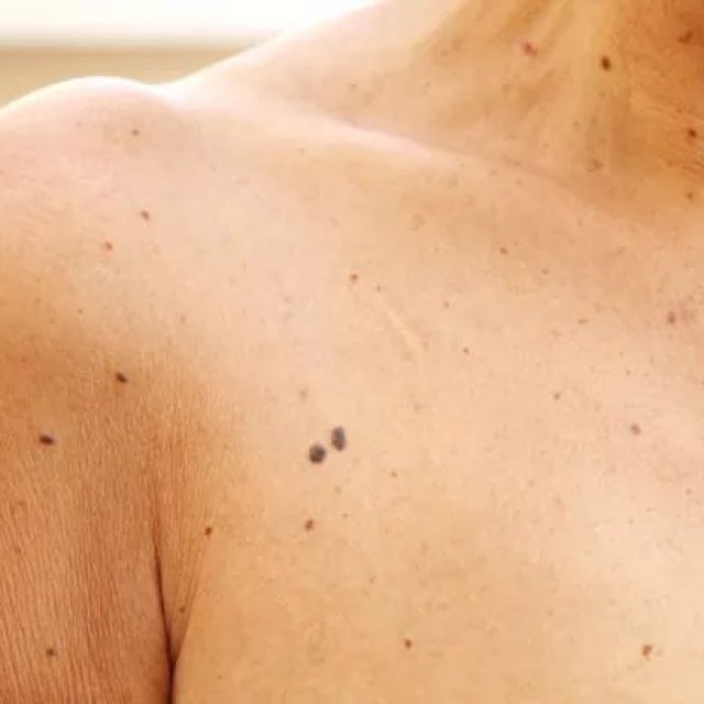 Skin Tag Removal: What Do You Need To Know?