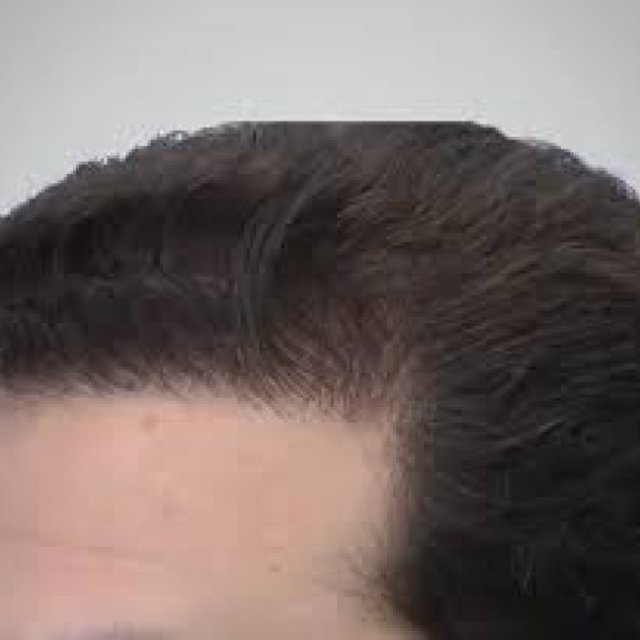 Hair Transplant: Styling Your New Hair