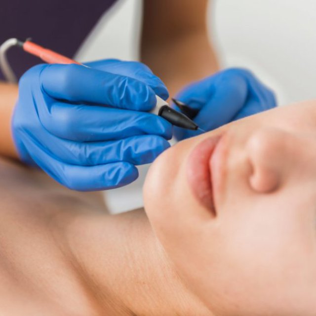 A Guide to Laser Electrolysis Cost in Dubai