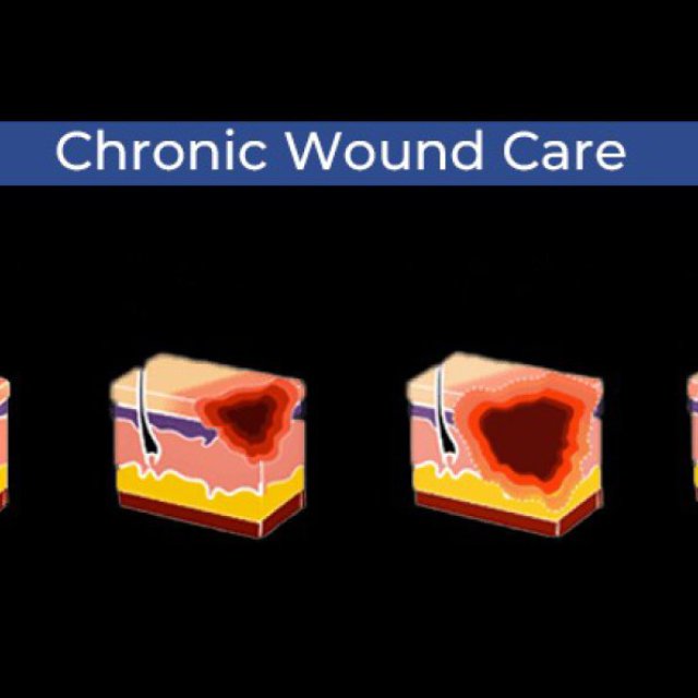 healing chronic wounds