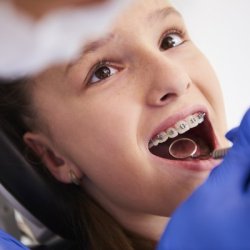 Damon Braces Treatment in Jumeirah