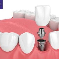 What Are Dental Implants?