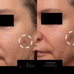Best Skin Clinic Melbourne - Nitai Skin & Laser Clinic