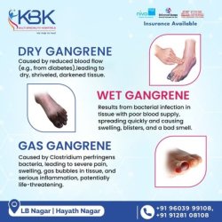 KBK Hospitals | gangrene treatment without surgery