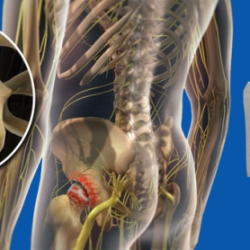 Dr. Vijay C. Bose Total Hip Replacement Surgery in India