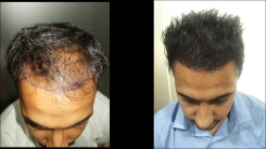 Evolve Esthetique Clinics - Hair Transplant Center Jaipur