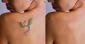 Best Laser Tattoo Removal Melbourne By City of Ink
