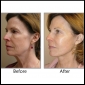 Best Face Lift Surgery in India - Divine Cosmetic Surgery