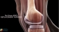 Knee Replacement Surgery Cost In Vashi At Bone And Joint Care Clinic