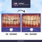 Tooth Implant Cost in Pune 32 Smiles Dental Clinic